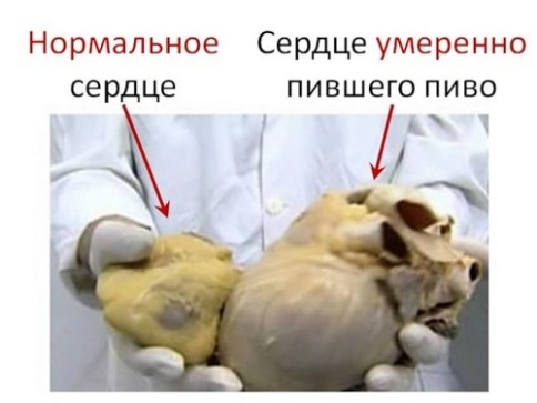 Профилактика сердечно – сосудистых заболеваний